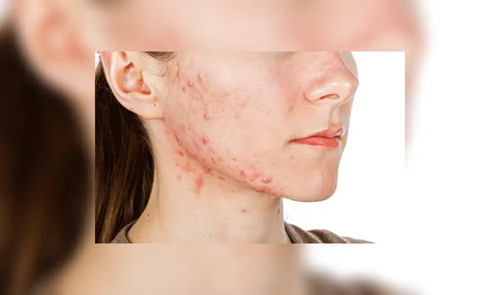 El acné y sus consecuencias