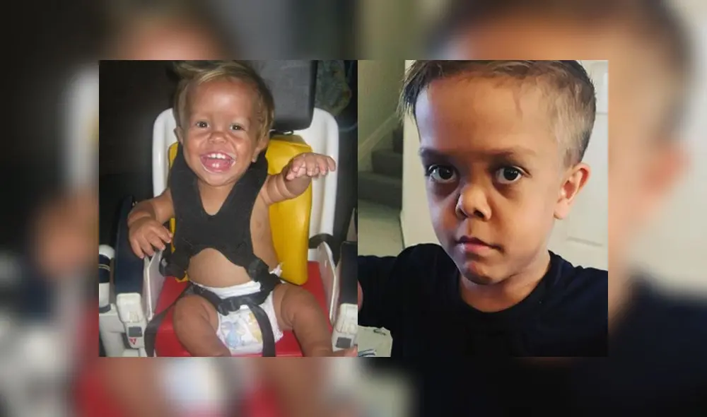 ¿Qué es el enanismo, el trastorno que afectó el crecimiento de Quaden Baileys?