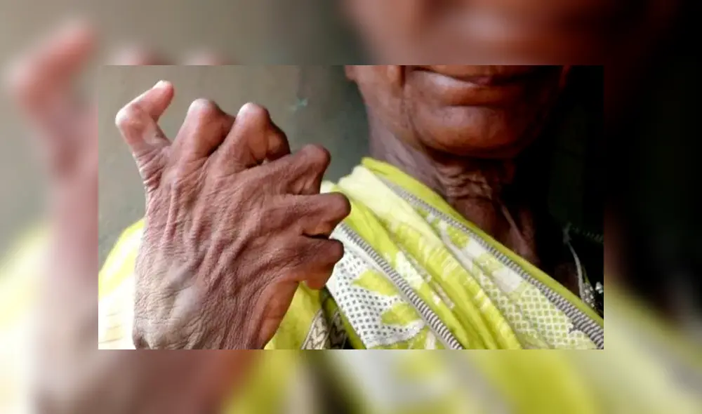 Mujer que nació con 20 dedos en los pies y 12 en las manos pide que no le digan ‘bruja’ [FOTOS] 