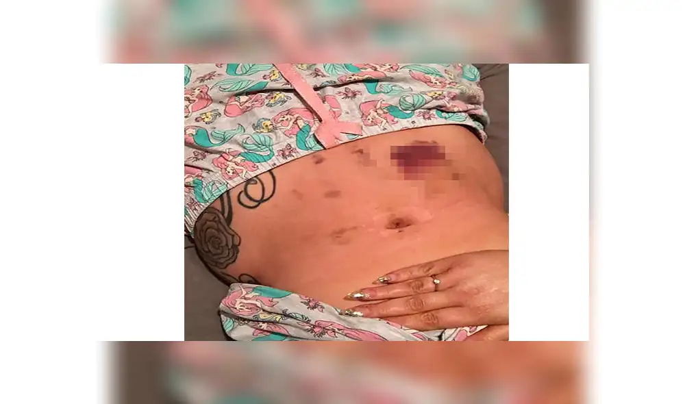Rara enfermedad obligó a mujer a reconstruirse el rostro con grasa de su estómago 