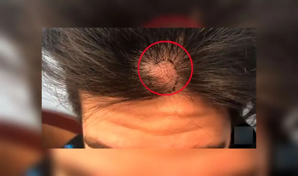 Le extirpan enorme quiste de su cuero cabelludo y lo abren para ver su interior [VIDEO]