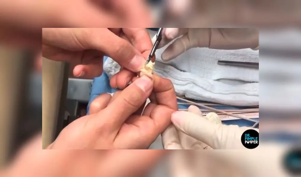 Le extirpan enorme quiste de su cuero cabelludo y lo abren para ver su interior [VIDEO]