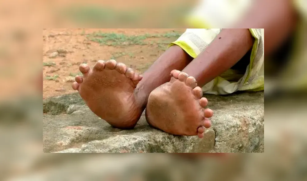 Mujer que nació con 20 dedos en los pies y 12 en las manos pide que no le digan ‘bruja’ [FOTOS] 