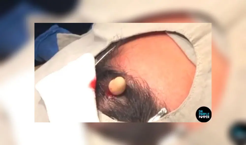 Le extirpan enorme quiste de su cuero cabelludo y lo abren para ver su interior [VIDEO]