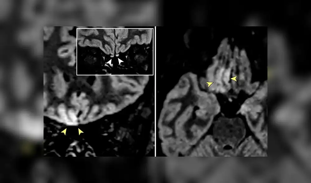 Imágenes que muestran hiperintensidad cortical en el giro recto derecho del cerebro. Foto: JAMA Neurology Imágenes que muestran hiperintensidad cortical en el giro recto derecho del cerebro. Foto: JAMA Neurology