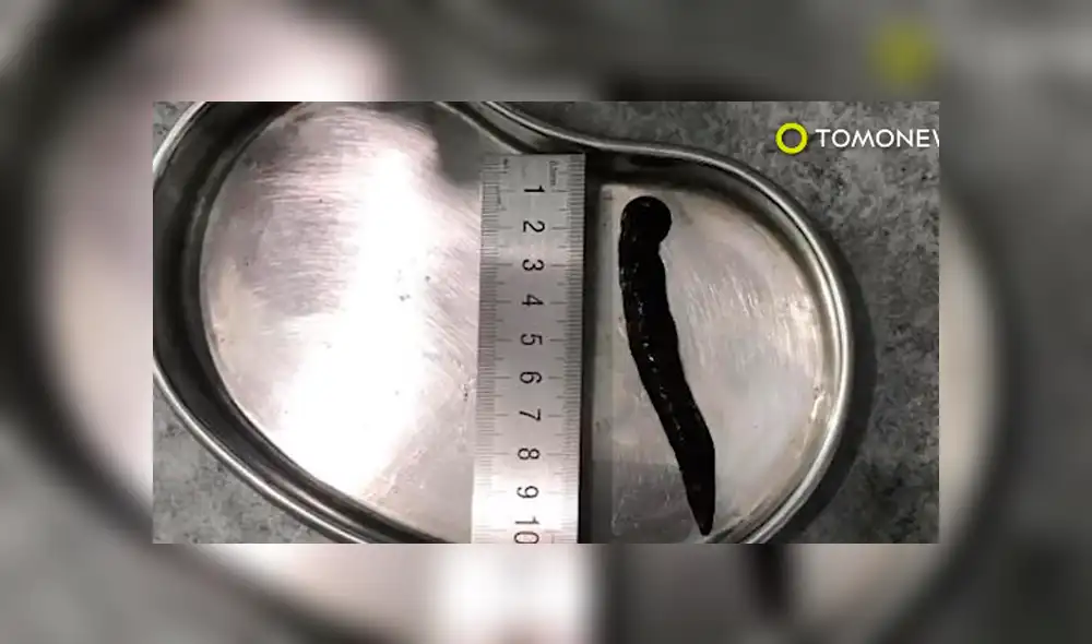 Fue al hospital para tratarse una tos y descubren dos parásitos alojados en su garganta