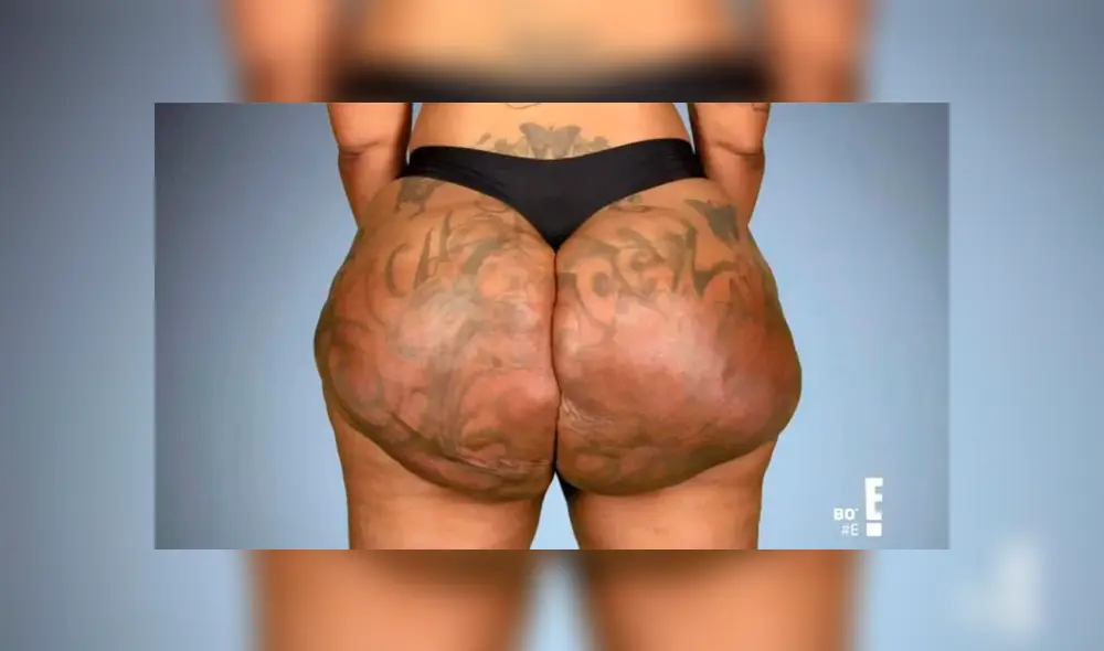 Mujer necesita que le amputen sus nalgas después de aumentarse con inyecciones ilegales [VIDEO]