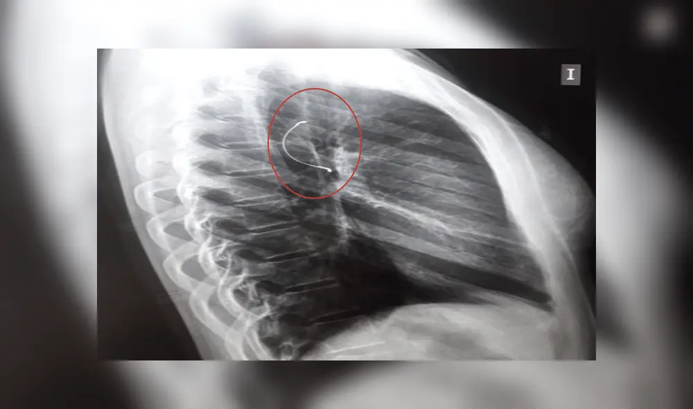 Adolescente se perfora la garganta al ingerir parte de sus brackets y sobrevive [FOTOS]