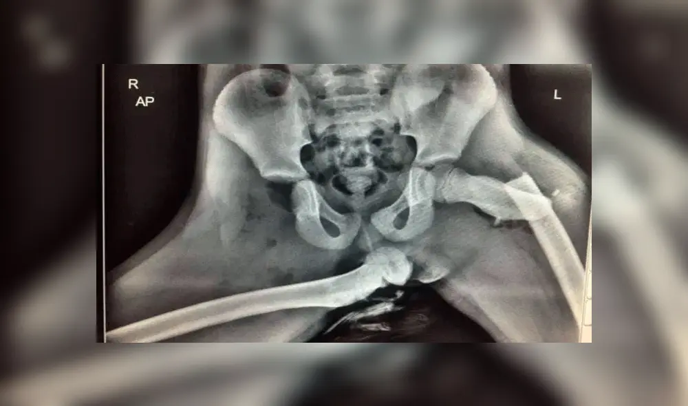 Mujer sufre terrible fractura en accidente por poner sus pies sobre el tablero de auto [FOTOS]