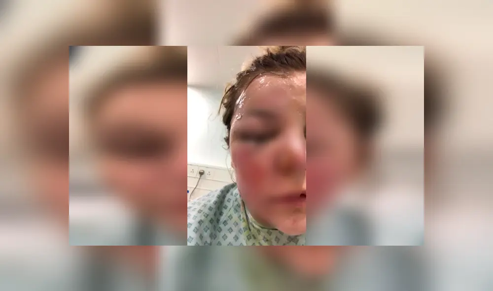 Puso a sancochar huevos en el microondas y explotaron en su cara dejándola ciega [FOTOS]