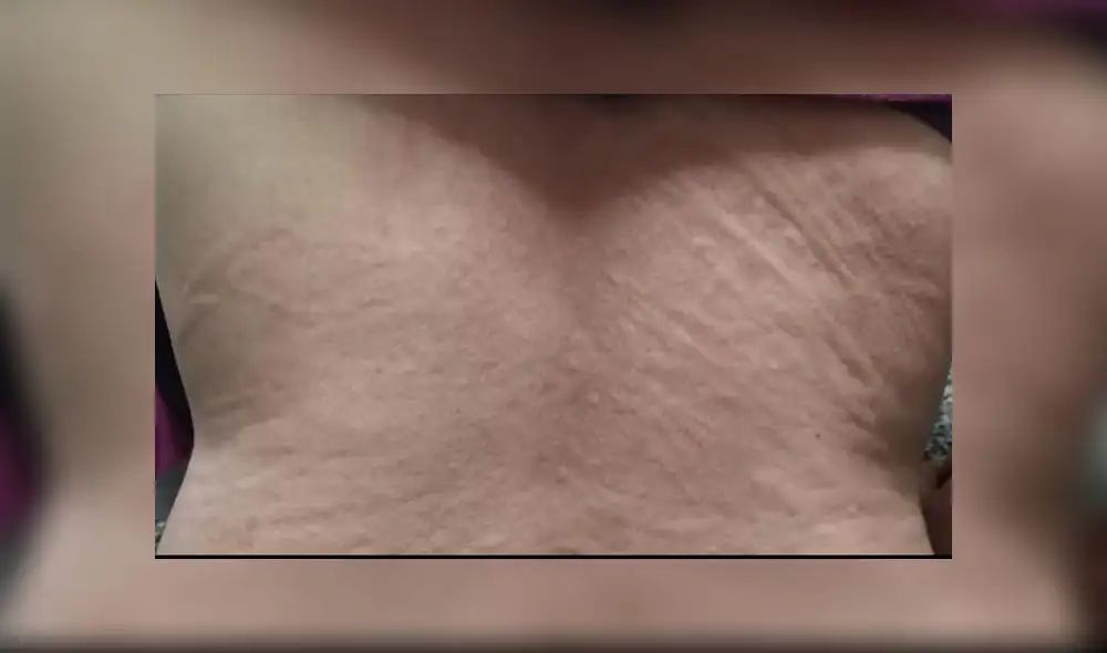 Se identificaron hasta 5 tipos de lesiones cutáneas asociadas al coronavirus. Imagen: AEDV. Se identificaron hasta 5 tipos de lesiones cutáneas asociadas al coronavirus. Imagen: AEDV.