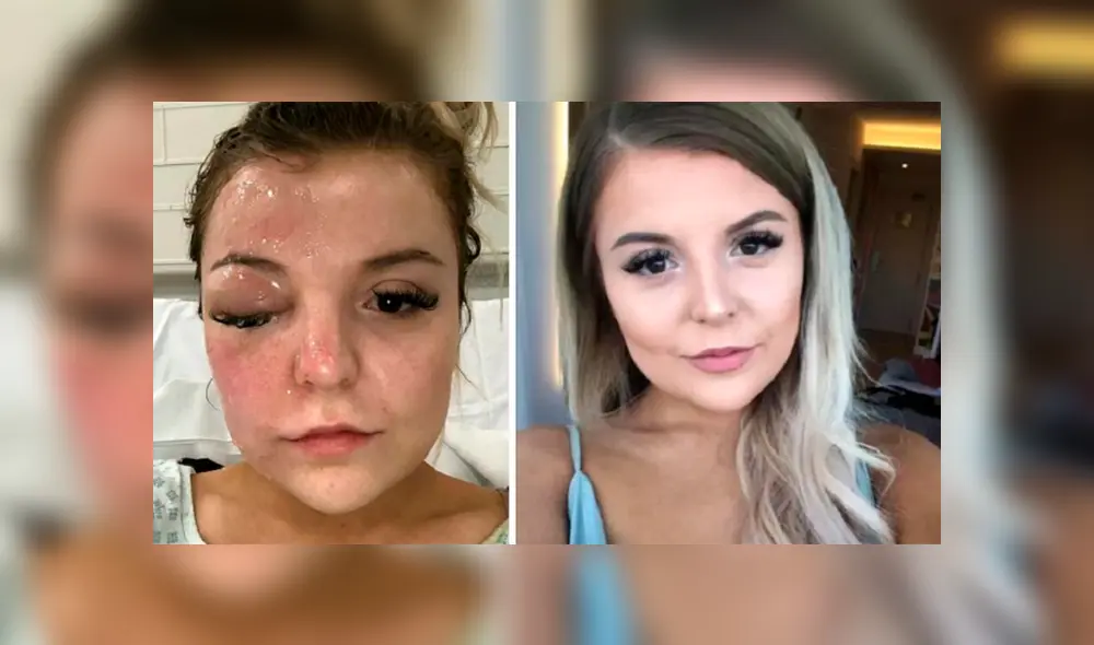 Puso a sancochar huevos en el microondas y explotaron en su cara dejándola ciega [FOTOS]