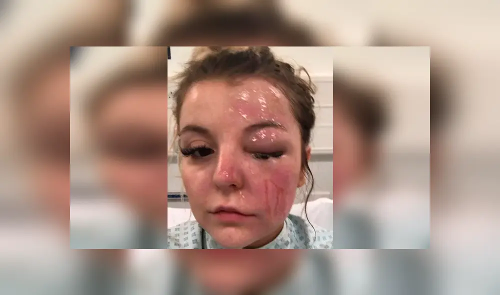 Puso a sancochar huevos en el microondas y explotaron en su cara dejándola ciega [FOTOS]