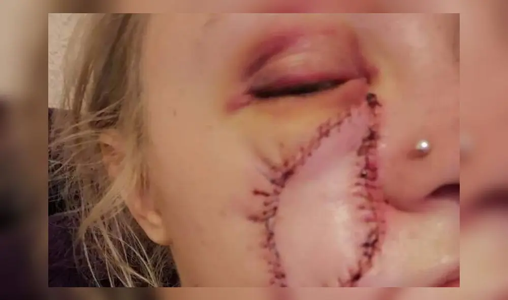 Louise Thorell se sometió a una cirugía para eliminar la cicatriz que le dejó el cáncer de piel. Foto: Difusión.