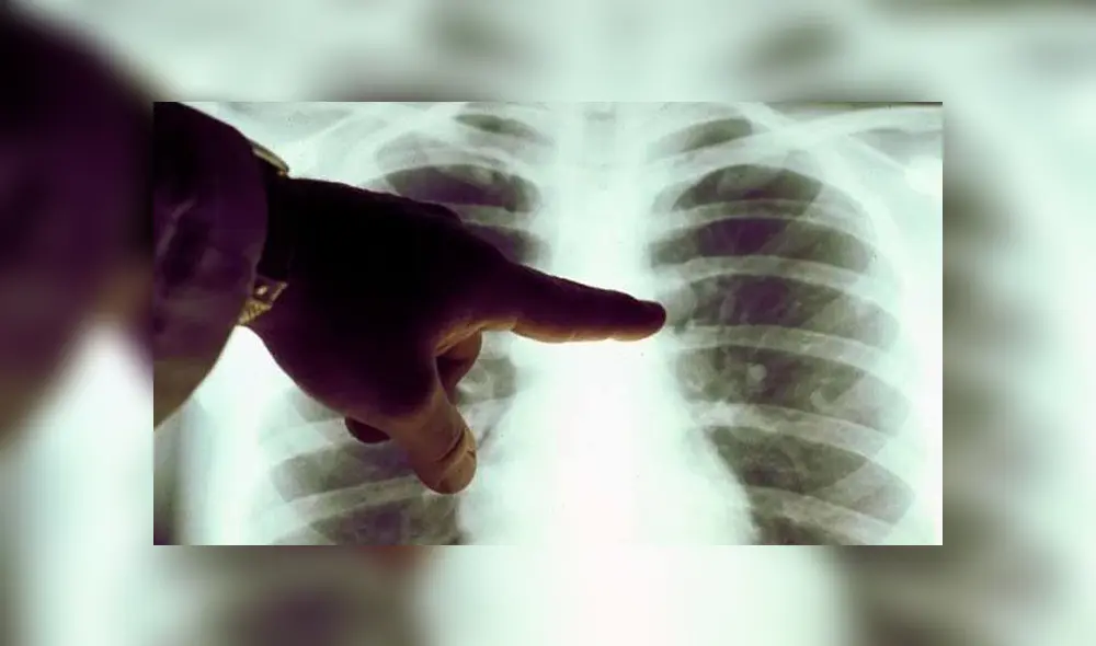 La neumonía es una enfermedad pulmonar.