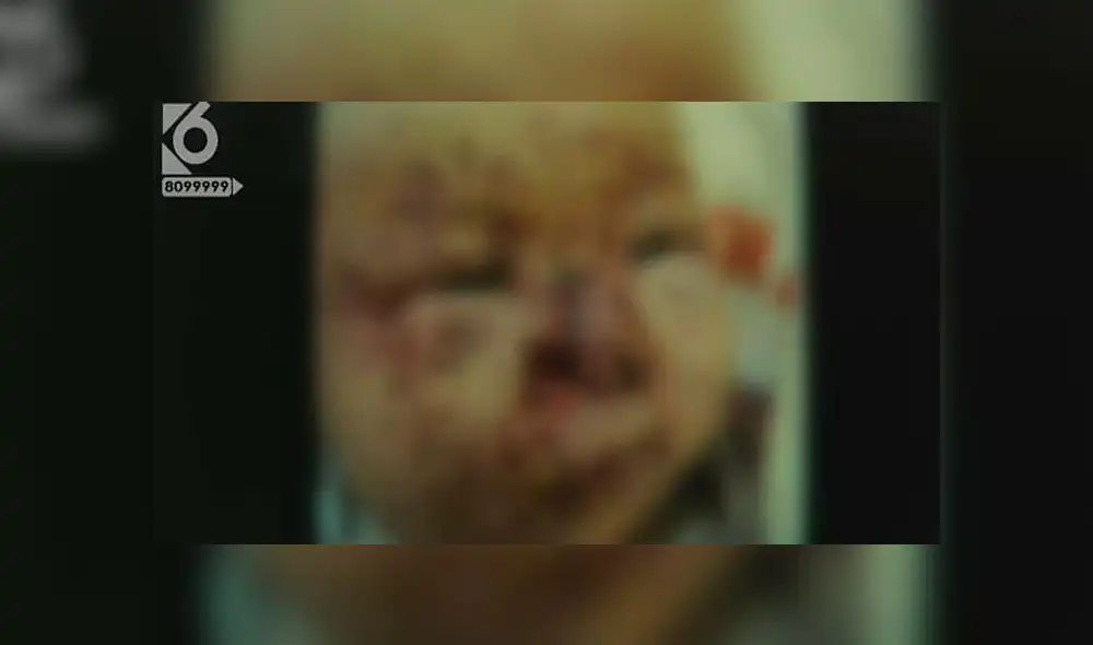 Bebé es mordida por ratones y queda con más de cien heridas en la cara