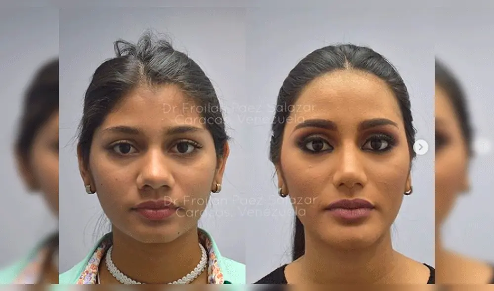 Filtran inéditas imágenes de Miss Venezuela antes de operaciones en el rostro