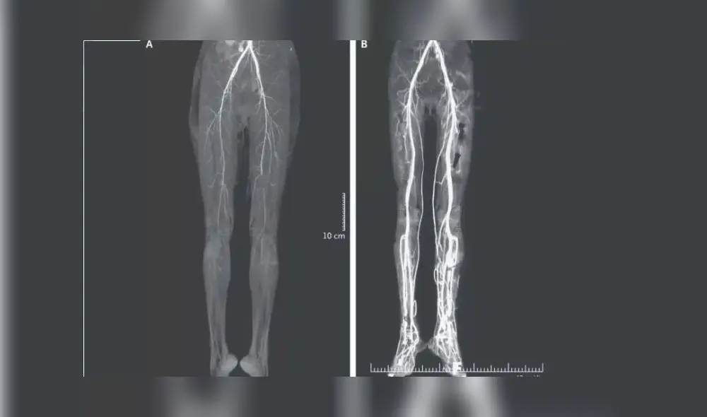 La imagen muestra una tomografía computarizada de las piernas de la mujer antes y después del tratamiento de la enfermedad. Foto: The New England Journal of Medicine. La imagen muestra una tomografía computarizada de las piernas de la mujer antes y después del tratamiento de la enfermedad. Foto: The New England Journal of Medicine.