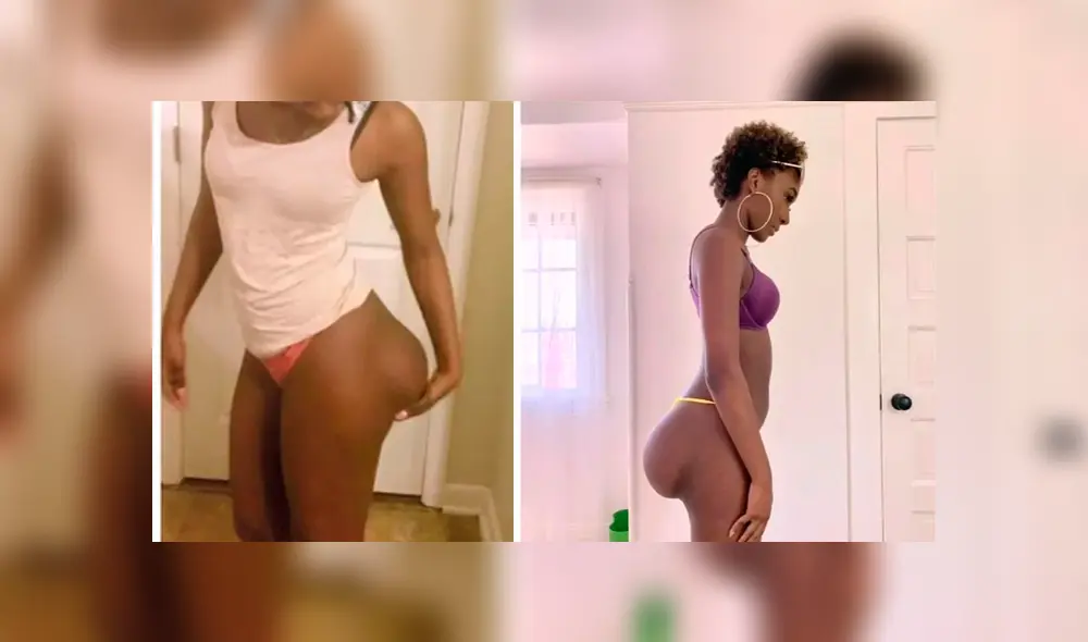 Mujer gastó 4 mil dólares por implantes de glúteos, pero el resultado fue desastroso [FOTOS]