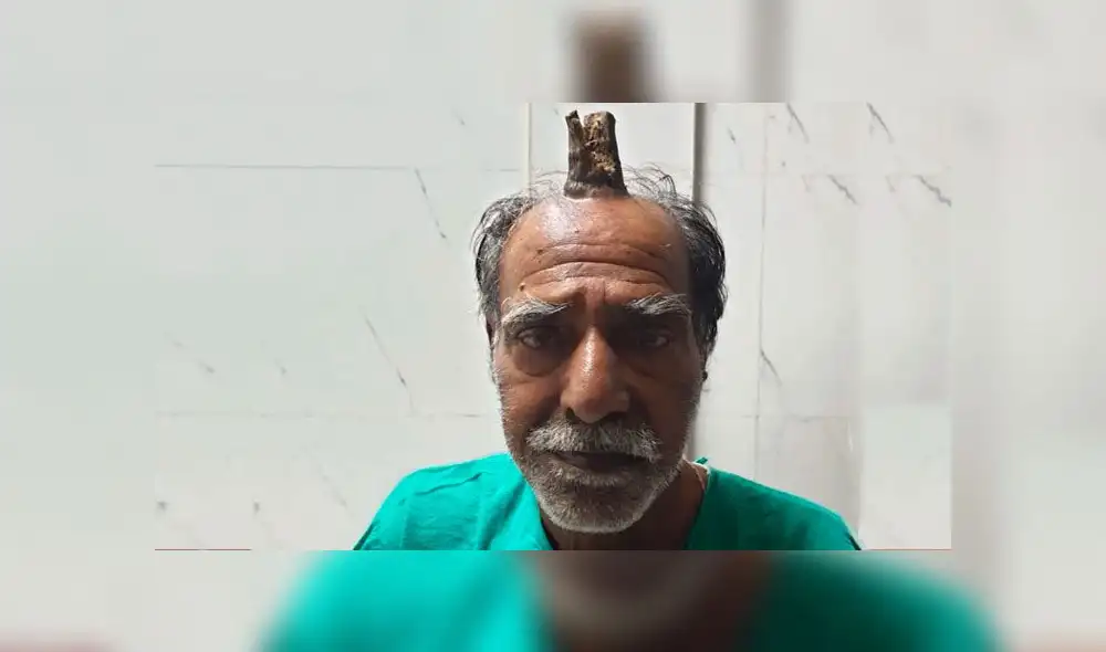 Shyam Lal Yadav sufrió un golpe y le comenzó a crecer un cuerno en la cabeza. Foto: difusión