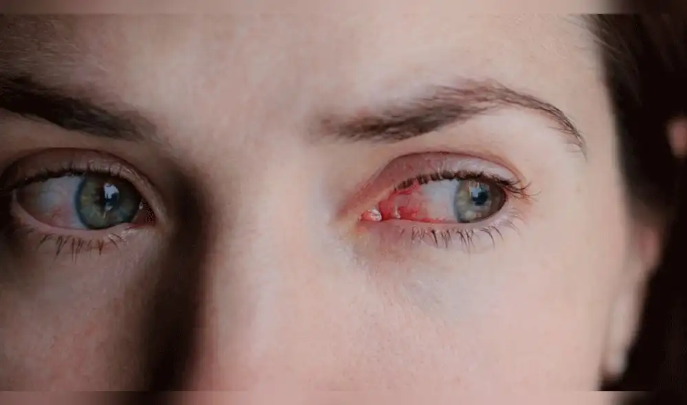 La conjuntivitis puede ocasionar disminución de la vista, advirtió el Minsa