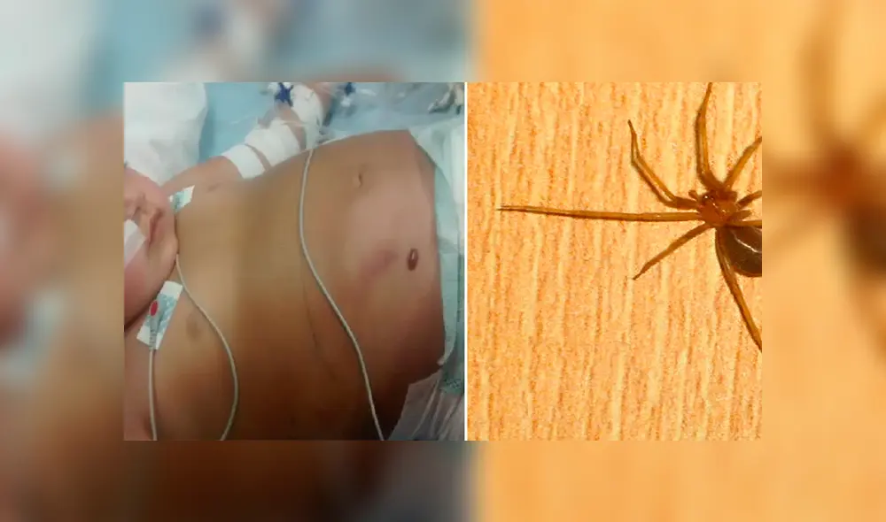 En terapia intensiva quedó una niña de 3 años por picadura de una araña de rincón [VIDEO]