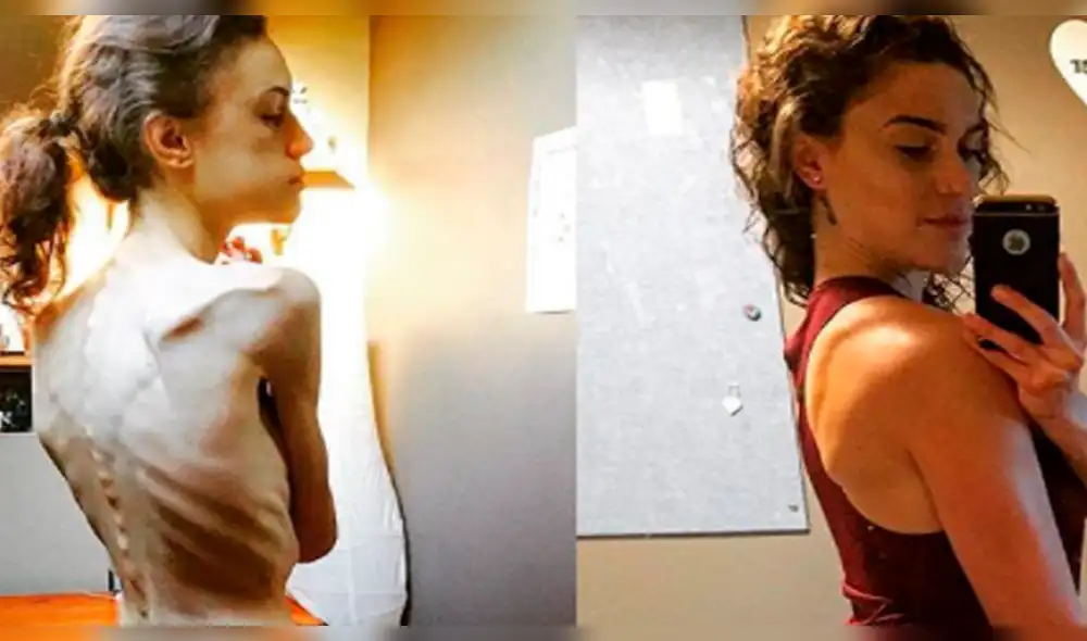 Instagram: mujer que sufrió anorexia comparte su increíble transformación  [FOTOS]