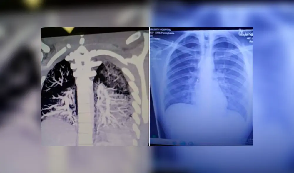 Así se ven los pulmones de Anthony Mayo. Foto: Facebook. Así se ven los pulmones de Anthony Mayo. Foto: Facebook.