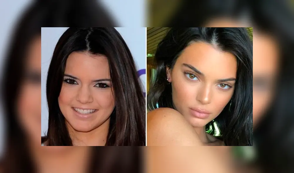 Kendall Jenner, antes y después de cirugías. Kendall Jenner, antes y después de cirugías.