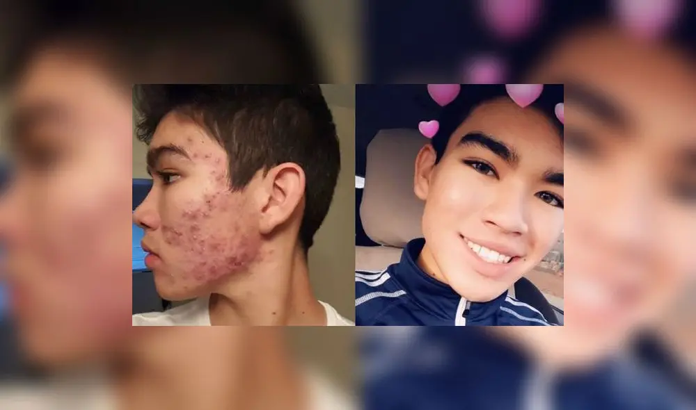 YouTube: el extraño tratamiento que uso adolescente para vencer acné severo  [VIDEO]