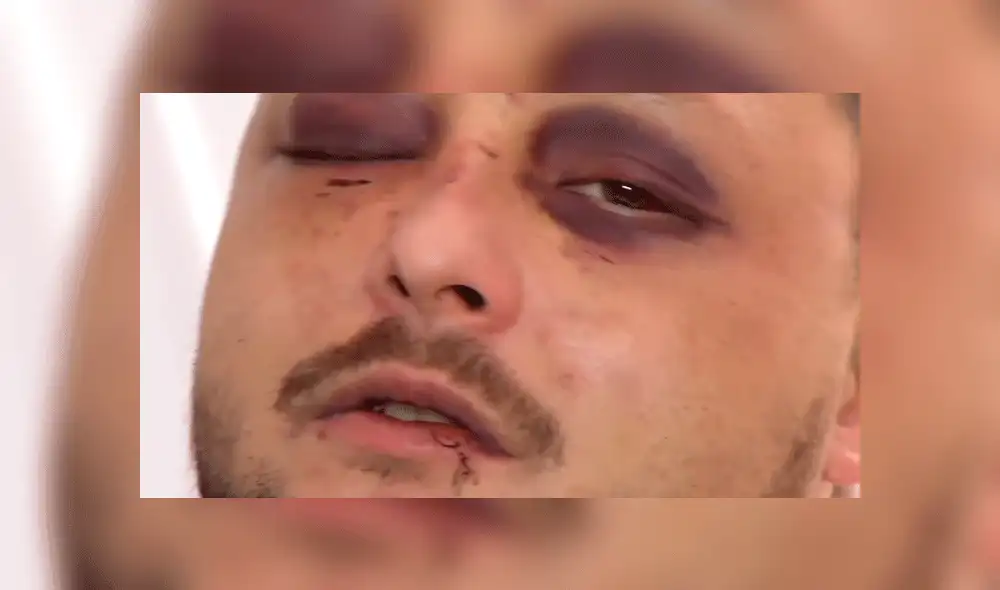 Queda con el rostro desfigurado tras defender a mujer maltratada por su pareja [VIDEO]