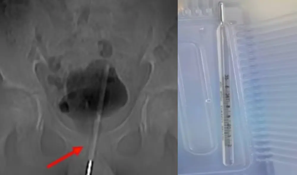 Menor pudo ser atendido con éxito y se le retiró termómetro del pene. Foto: Difusión/DailyMail Menor pudo ser atendido con éxito y se le retiró termómetro del pene. Foto: Difusión/DailyMail