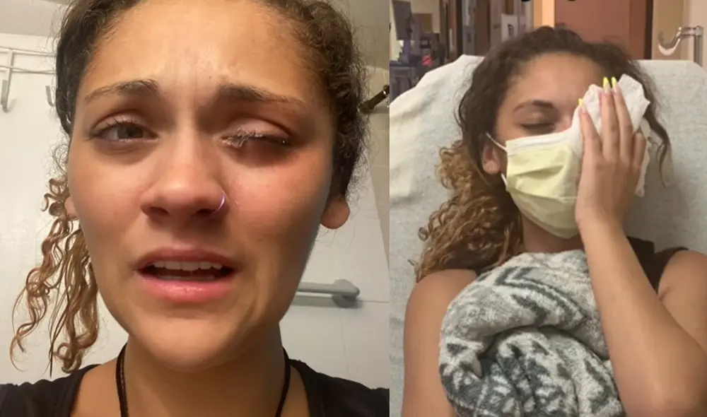 La joven compartió en su cuenta de TikTok todo el proceso por el que tuvo que pasar para liberar su ojo del pegamento. Foto: captura captura/@icyylyd / TikTok La joven compartió en su cuenta de TikTok todo el proceso por el que tuvo que pasar para liberar su ojo del pegamento. Foto: captura captura/@icyylyd / TikTok