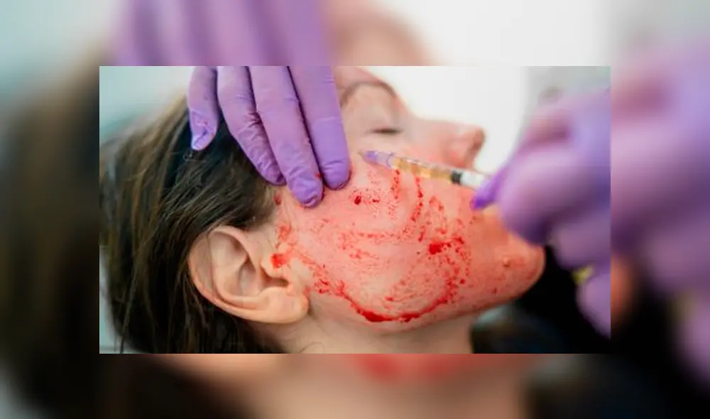 Mujeres contraen VIH al realizarse tratamiento facial de plasma