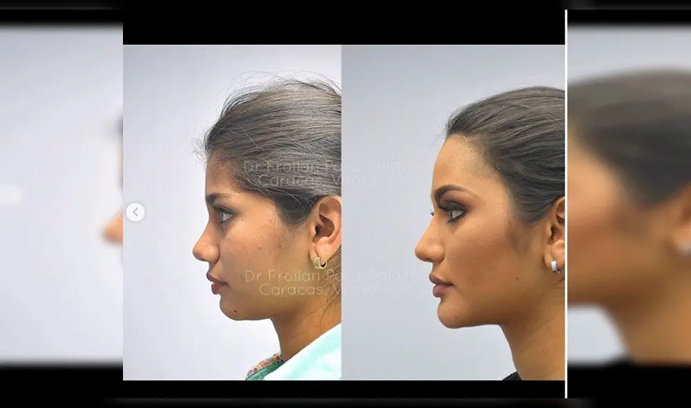 Filtran inéditas imágenes de Miss Venezuela antes de operaciones en el rostro