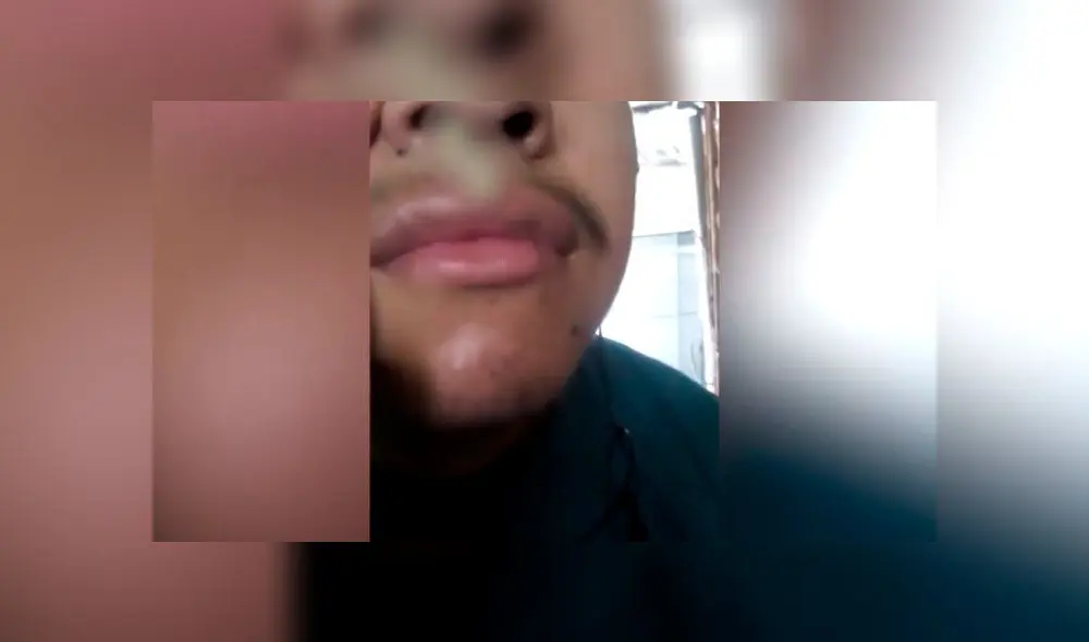 Negligencia en hospital de Collique: médicos dejaron gasa en nariz de universitario [VIDEO]