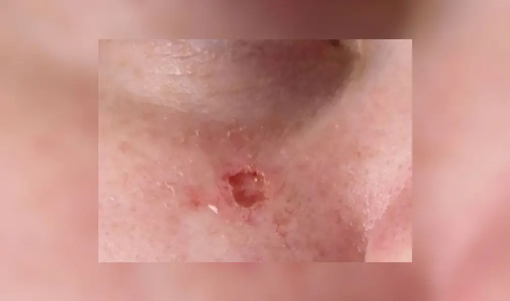 Louise Thorell se sometió a una cirugía para eliminar la cicatriz que le dejó el cáncer de piel. Foto: Difusión.