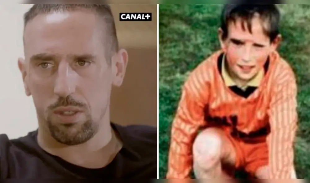 Frank Ribery sobre su cicatriz: "La gente siempre miraba mi rostro, sufrí" Frank Ribery sobre su cicatriz: "La gente siempre miraba mi rostro, sufrí"
