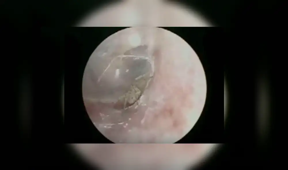 YouTube viral: médico revisa oído de joven y encuentra terrorífica criatura en su interior [VIDEO]