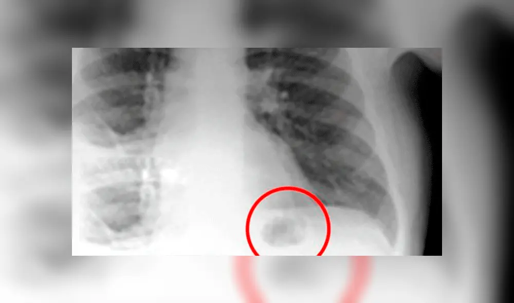 Creyó que una mancha en sus pulmones era cáncer, pero se llevó tremenda sorpresa al descubrir la verdad [FOTO]