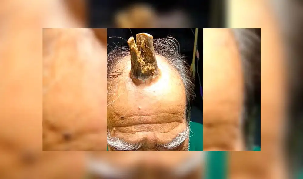 Shyam Lal Yadav sufrió un golpe y le comenzó a crecer un cuerno en la cabeza. Foto: difusión