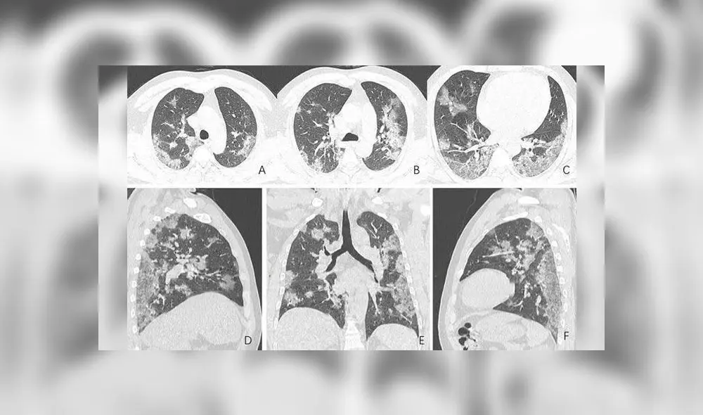 Tomografías muestran el daño que causa el coronavirus en los pulmones [FOTOS]