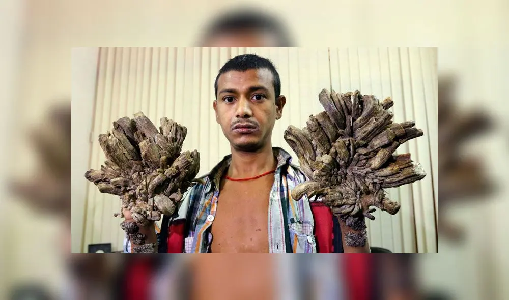 Abul Bajandar fue conocido en 2016 como el 'hombre árbol' y hoy hace triste pedido. Foto: AFP Abul Bajandar fue conocido en 2016 como el 'hombre árbol' y hoy hace triste pedido. Foto: AFP
