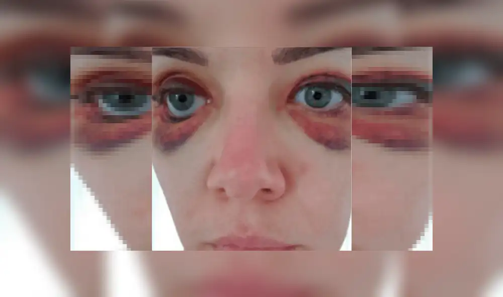 Mujer terminó con los párpados destrozados tras hacerse delineado permanente Mujer terminó con los párpados destrozados tras hacerse delineado permanente