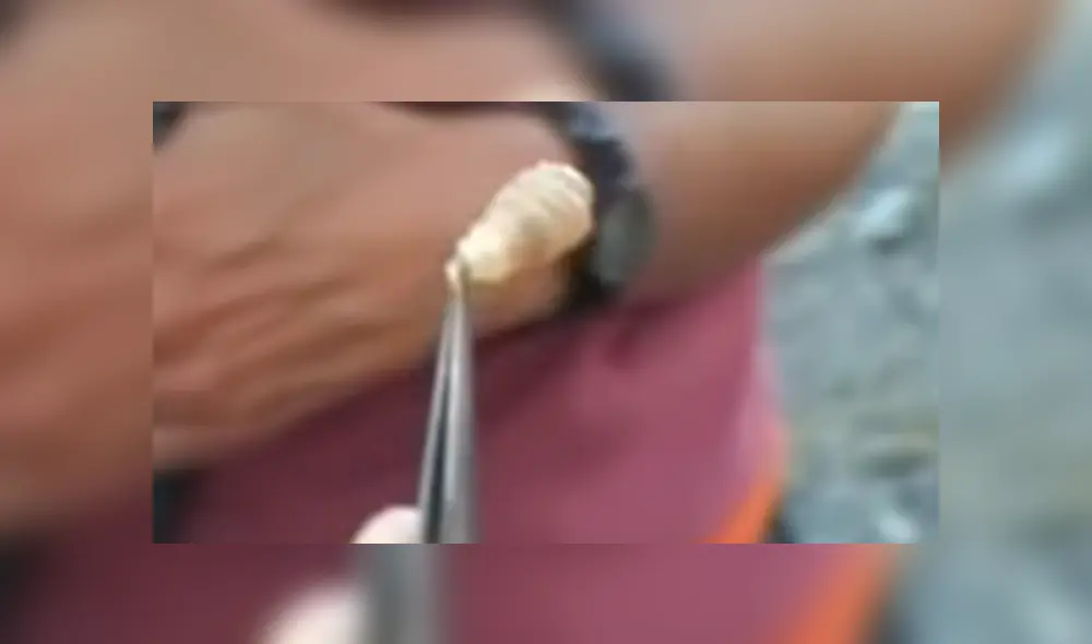 YouTube viral: joven va al médico por roncha en su espalda y le hacen espeluznante hallazgo [VIDEO]