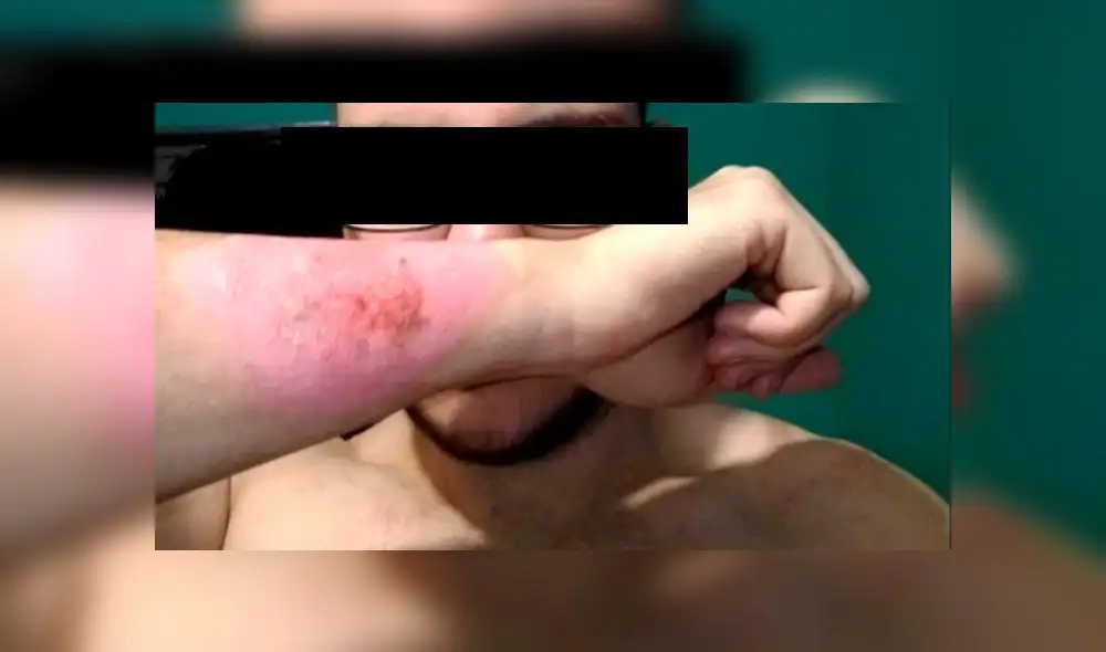 Joven se quita tatuaje