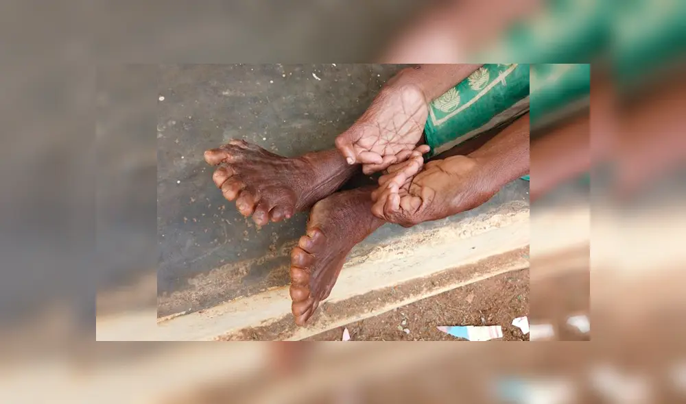 Mujer con 31 dedos en manos y pies rompe récord, pero sus vecinos la llaman ‘bruja’ [VIDEO]