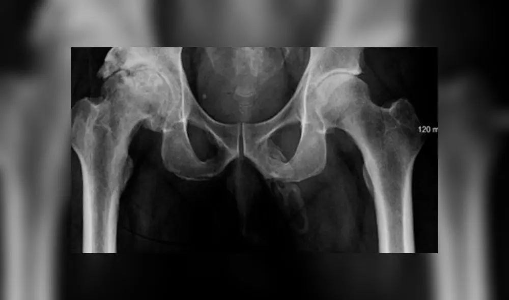 Hombre acude al médico y descubre que su pene se está convirtiendo en hueso [FOTOS]