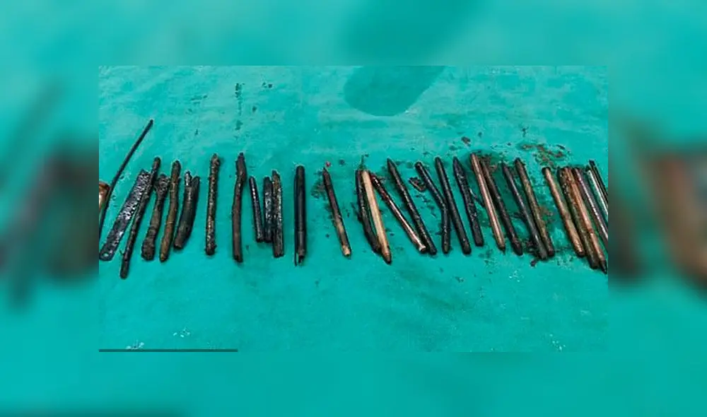 Médicos se sorprendieron al ver lo que tenía en su estómago un agricultor en la India. Newslions.