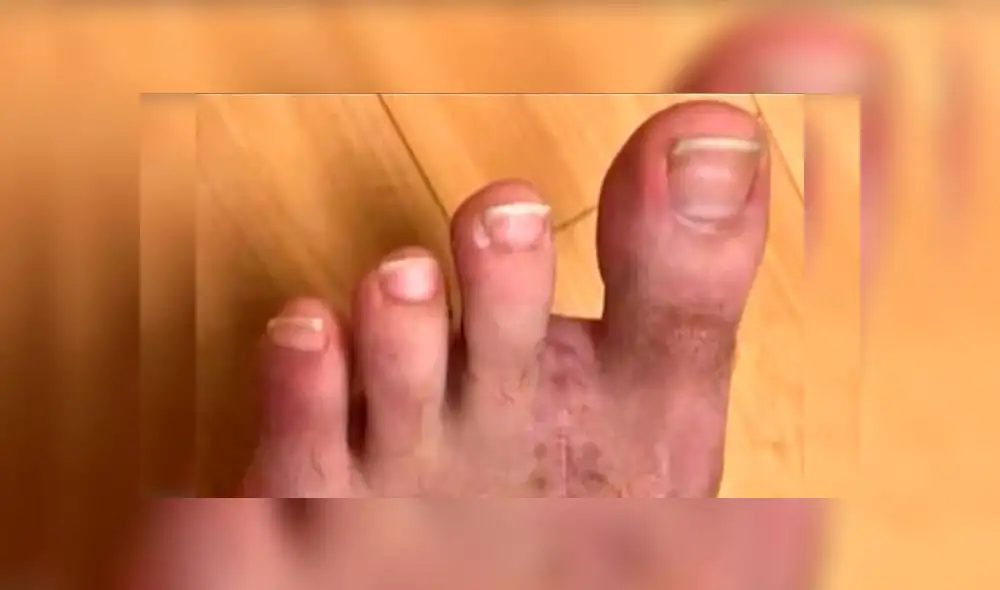 Cirujanos extirpan dedo del pie a paciente para reemplazar el pulgar de su mano [FOTOS]